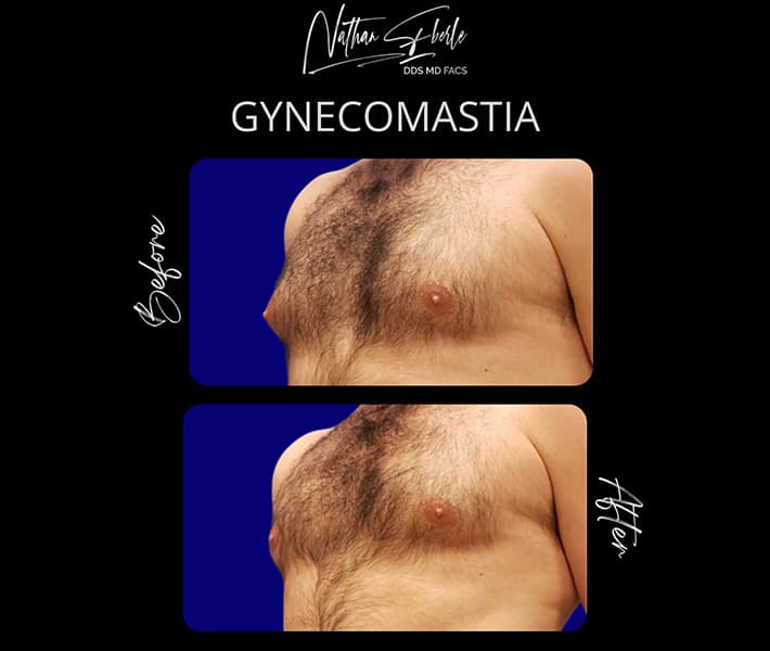 Gynecomastia before and after case 26, actual patient at Weston Center for Plastic Surgery