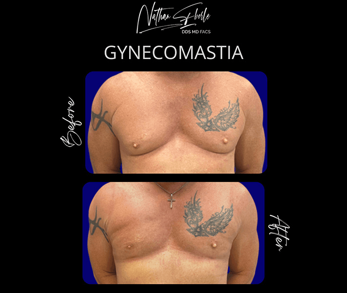 Gynecomastia before and after case 27, actual patient at Weston Center for Plastic Surgery
