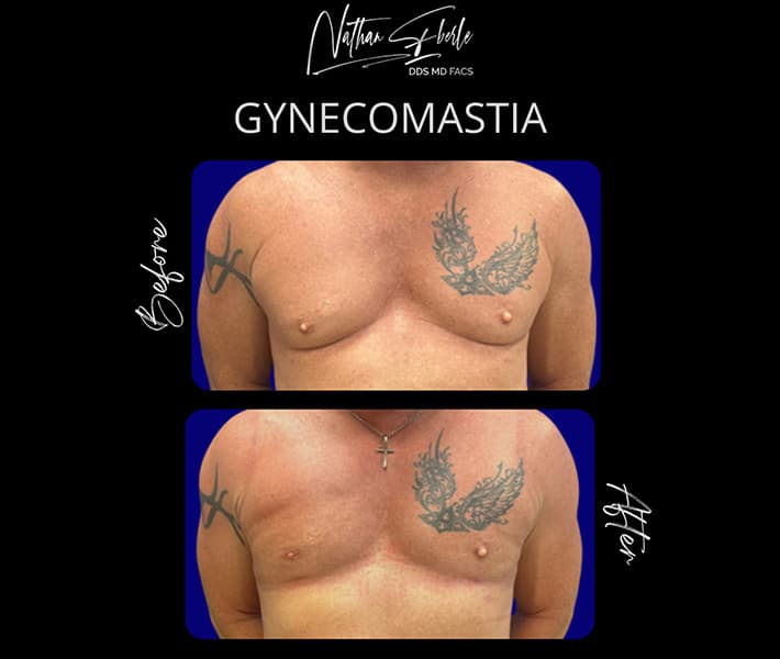 Gynecomastia before and after case 27, actual patient at Weston Center for Plastic Surgery