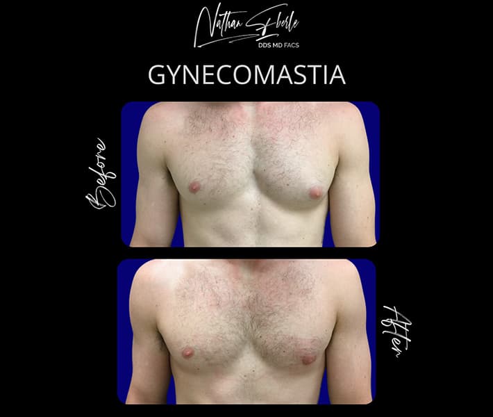 Gynecomastia before and after case 28, actual patient at Weston Center for Plastic Surgery