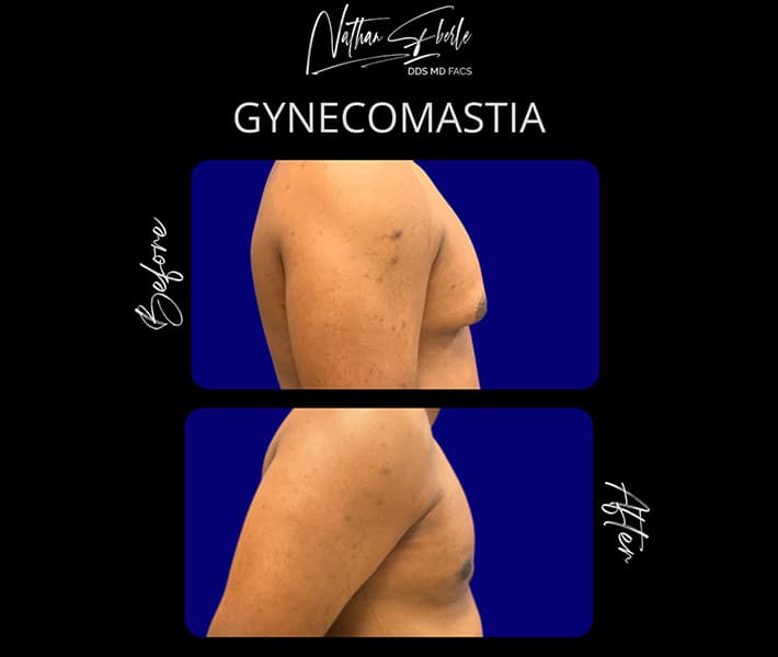 Gynecomastia before and after case 29, actual patient at Weston Center for Plastic Surgery