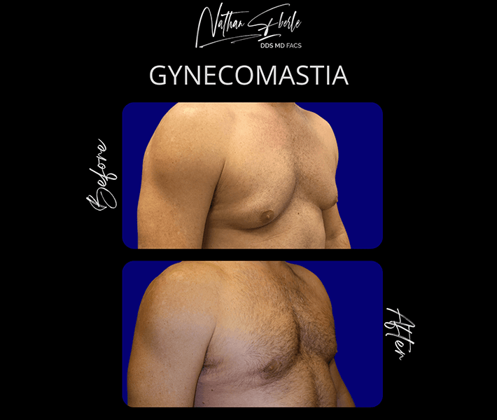 Gynecomastia before and after case 3, actual patient at Weston Center for Plastic Surgery