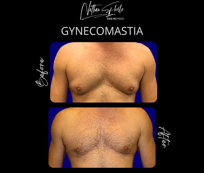 Gynecomastia before and after case 30, actual patient at Weston Center for Plastic Surgery