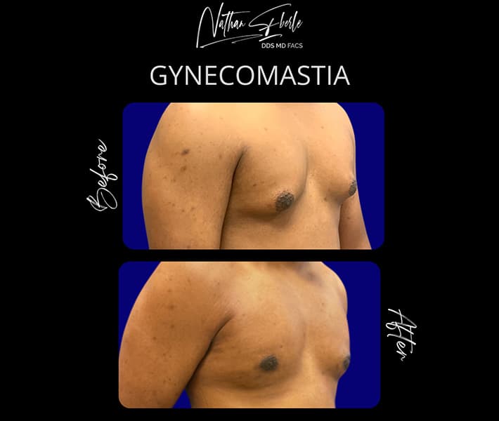 Gynecomastia before and after case 31, actual patient at Weston Center for Plastic Surgery