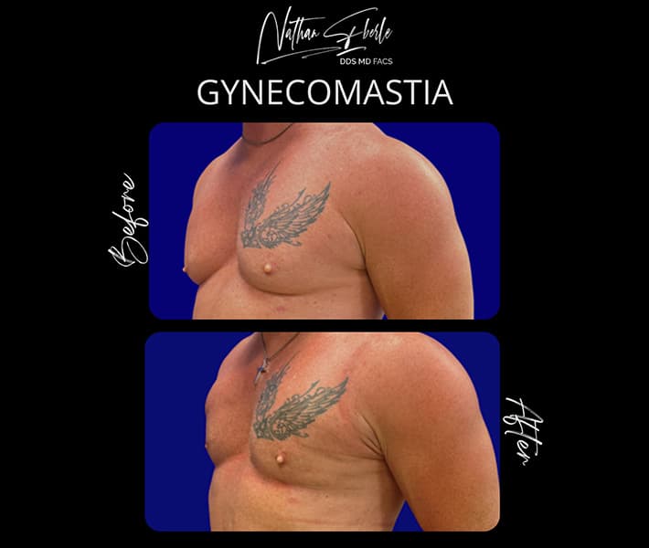 Gynecomastia before and after case 32, actual patient at Weston Center for Plastic Surgery