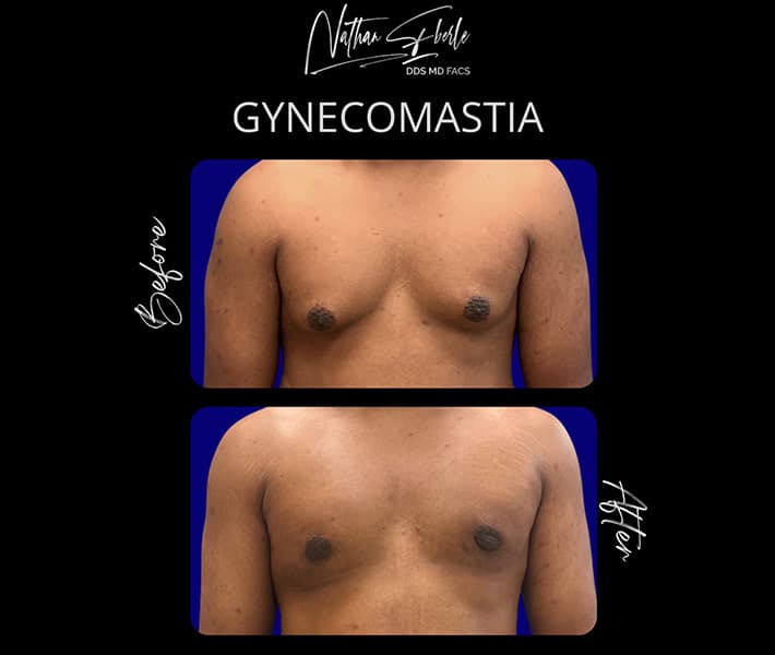 Gynecomastia before and after case 33, actual patient at Weston Center for Plastic Surgery