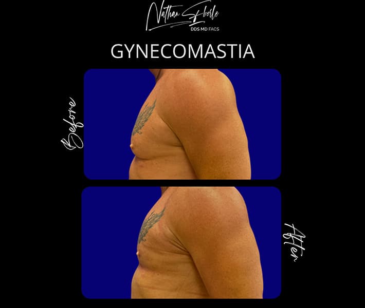 Gynecomastia before and after case 34, actual patient at Weston Center for Plastic Surgery