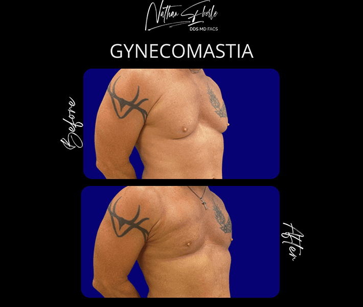 Gynecomastia before and after case 35, actual patient at Weston Center for Plastic Surgery