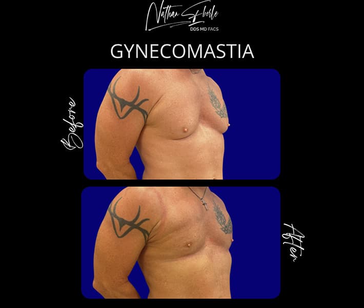 Gynecomastia before and after case 35, actual patient at Weston Center for Plastic Surgery