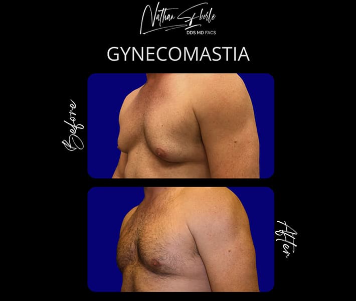 Gynecomastia before and after case 36, actual patient at Weston Center for Plastic Surgery