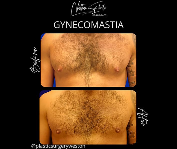 Gynecomastia before and after case 37, actual patient at Weston Center for Plastic Surgery