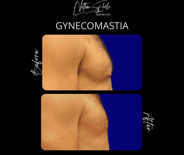 Gynecomastia case 38 before and after results at Weston Center for Plastic Surgery