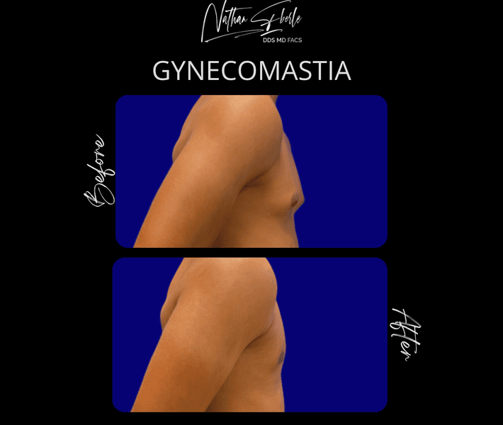 Gynecomastia case 39 before and after results at Weston Center for Plastic Surgery