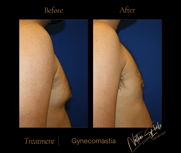 Gynecomastia before and after case 4, actual patient at Weston Center for Plastic Surgery