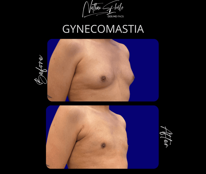 Gynecomastia case 40 before and after results at Weston Center for Plastic Surgery