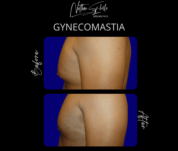 Gynecomastia case 41 before and after results at Weston Center for Plastic Surgery