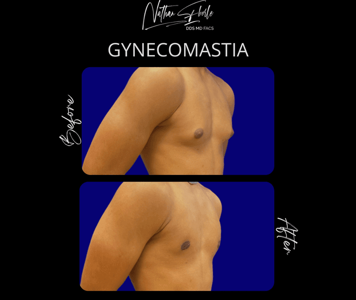 Gynecomastia case 42 before and after results at Weston Center for Plastic Surgery