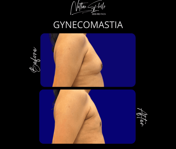 Gynecomastia case 43 before and after results at Weston Center for Plastic Surgery