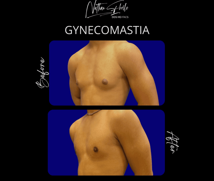 Gynecomastia case 44 before and after results at Weston Center for Plastic Surgery