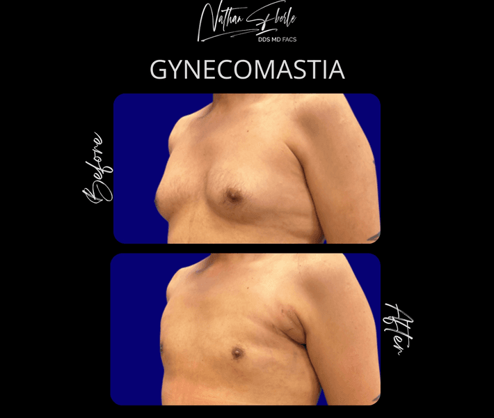 Gynecomastia case 45 before and after results at Weston Center for Plastic Surgery
