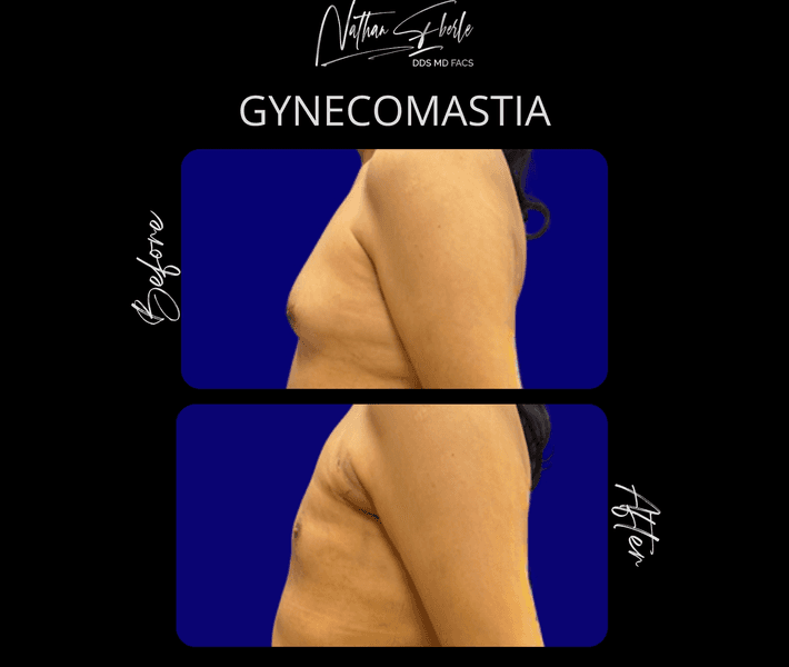 Gynecomastia case 46 before and after results at Weston Center for Plastic Surgery