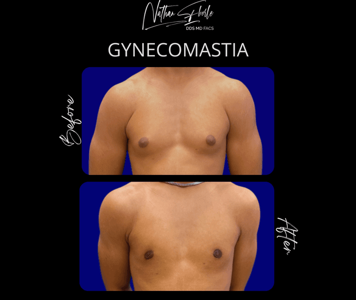 Gynecomastia case 47 before and after results at Weston Center for Plastic Surgery
