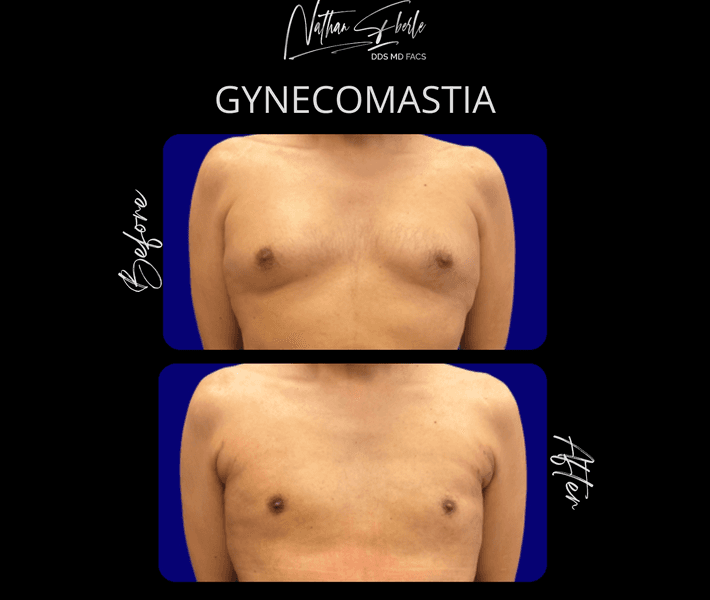 Gynecomastia case 48 before and after results at Weston Center for Plastic Surgery