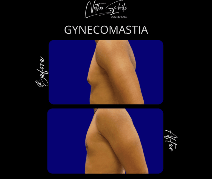 Gynecomastia case 49 before and after results at Weston Center for Plastic Surgery