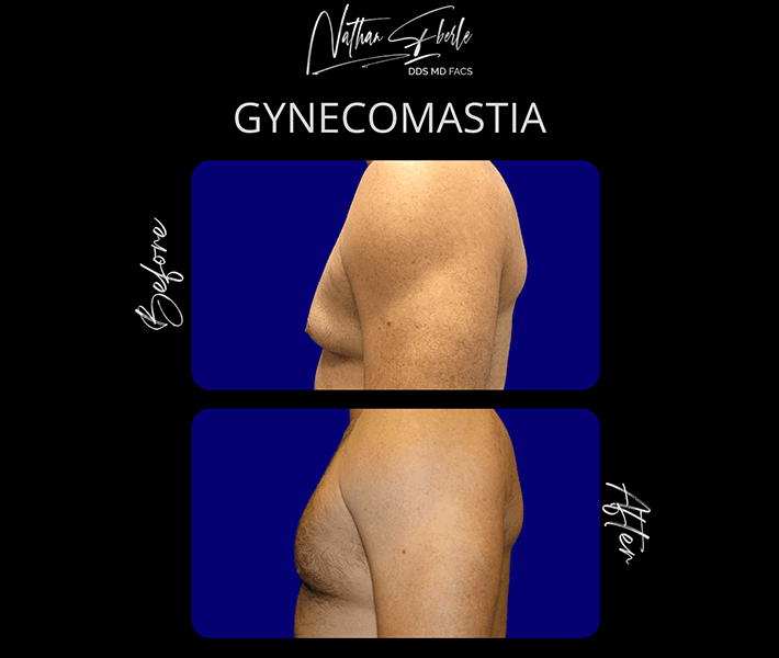Gynecomastia before and after case 5, actual patient at Weston Center for Plastic Surgery