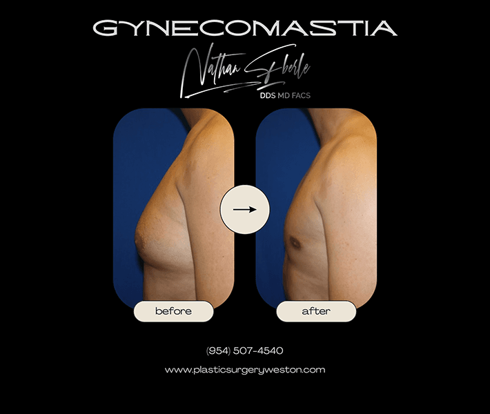 Gynecomastia before and after case 6, actual patient at Weston Center for Plastic Surgery