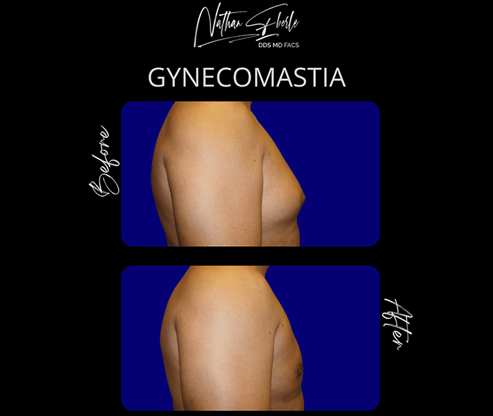 Gynecomastia before and after case 7, actual patient at Weston Center for Plastic Surgery