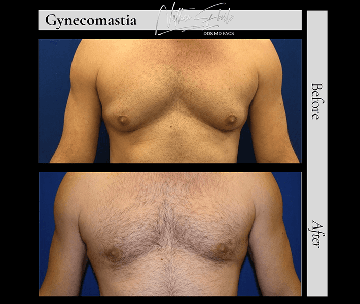Gynecomastia before and after case 8, actual patient at Weston Center for Plastic Surgery