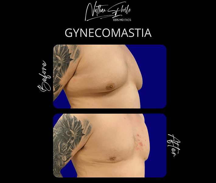 Gynecomastia before and after case 9, actual patient at Weston Center for Plastic Surgery