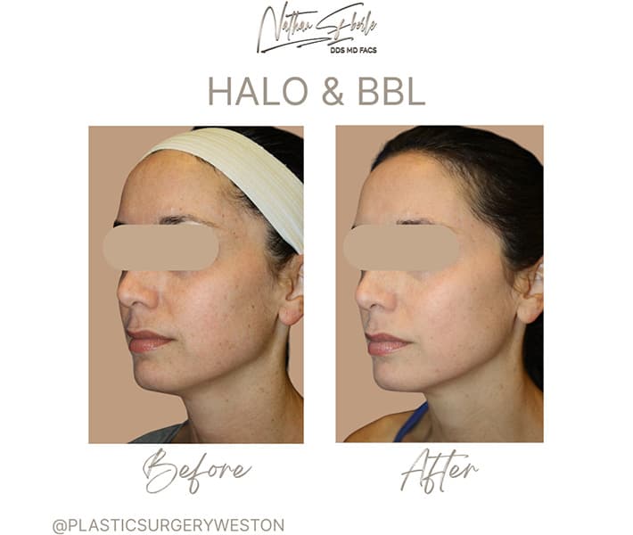Halo Laser before and after case 1, actual patient at Weston Center for Plastic Surgery