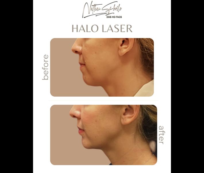 Halo Laser case 2 before and after results at Weston Center for Plastic Surgery