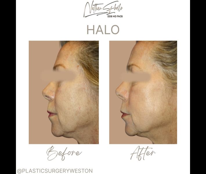Halo Laser case 3 before and after results at Weston Center for Plastic Surgery