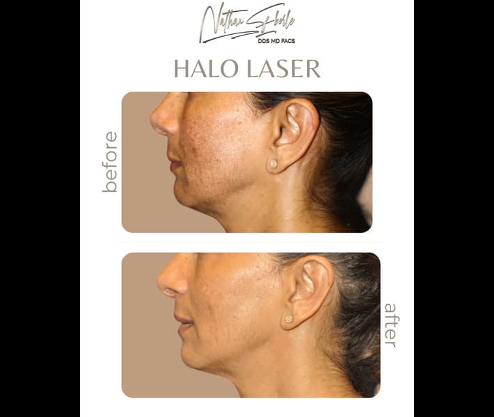 Halo Laser case 4 before and after results at Weston Center for Plastic Surgery