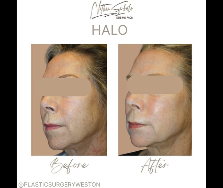 Halo Laser case 5 before and after results at Weston Center for Plastic Surgery