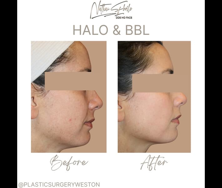 Halo Laser case 6 before and after results at Weston Center for Plastic Surgery