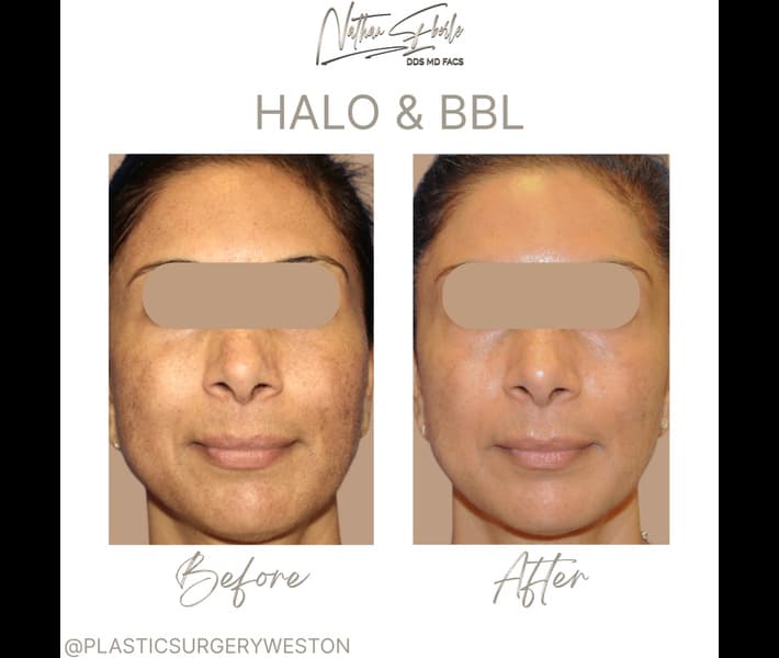 Halo Laser case 7 before and after results at Weston Center for Plastic Surgery