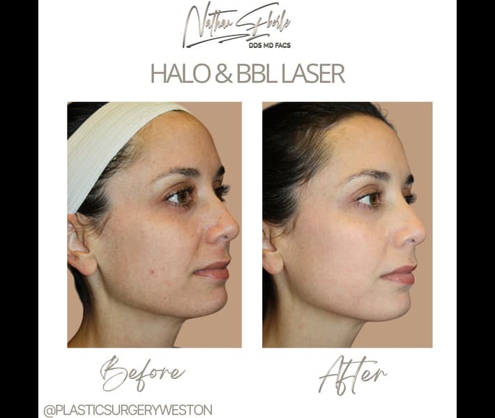 Halo Laser case 8 before and after results at Weston Center for Plastic Surgery