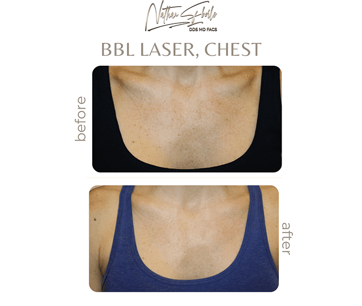 Laser before and after case 1, actual patient at Weston Center for Plastic Surgery