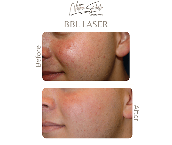 Laser before and after case 2, actual patient at Weston Center for Plastic Surgery