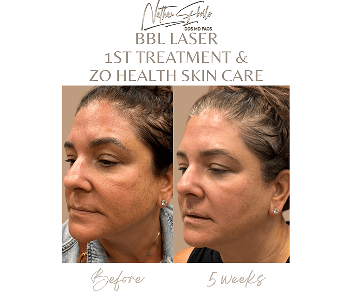 Laser before and after case 3, actual patient at Weston Center for Plastic Surgery