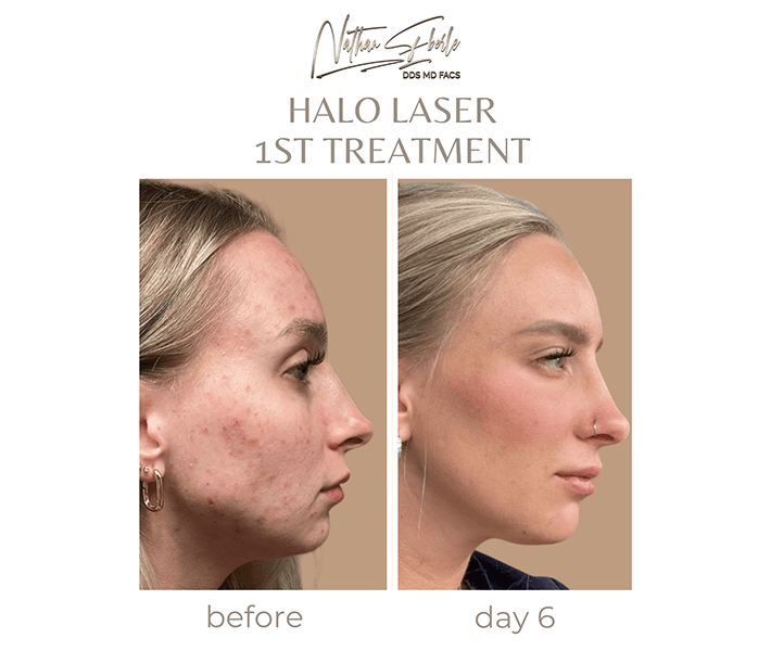 Laser before and after case 4, actual patient at Weston Center for Plastic Surgery