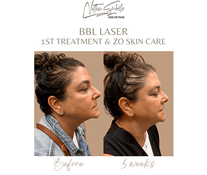 Laser before and after case 5, actual patient at Weston Center for Plastic Surgery
