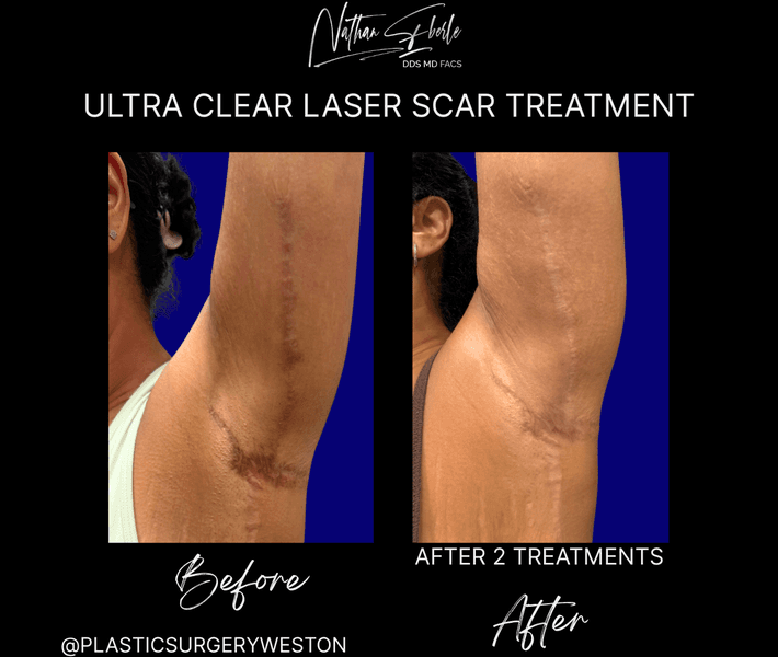 Laser case 6 before and after results at Weston Center for Plastic Surgery