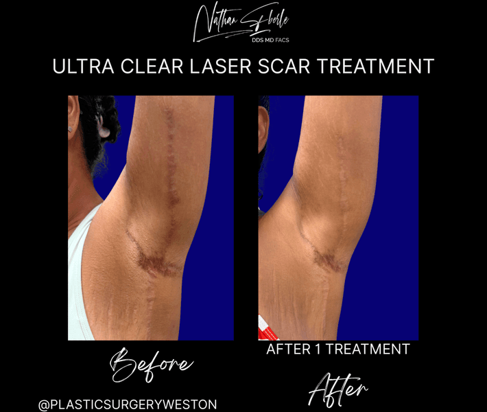 Laser case 7 before and after results at Weston Center for Plastic Surgery