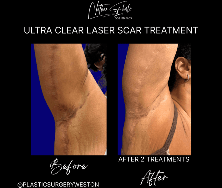 Laser case 8 before and after results at Weston Center for Plastic Surgery