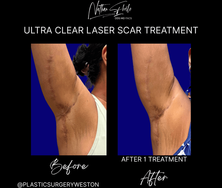 Laser case 9 before and after results at Weston Center for Plastic Surgery